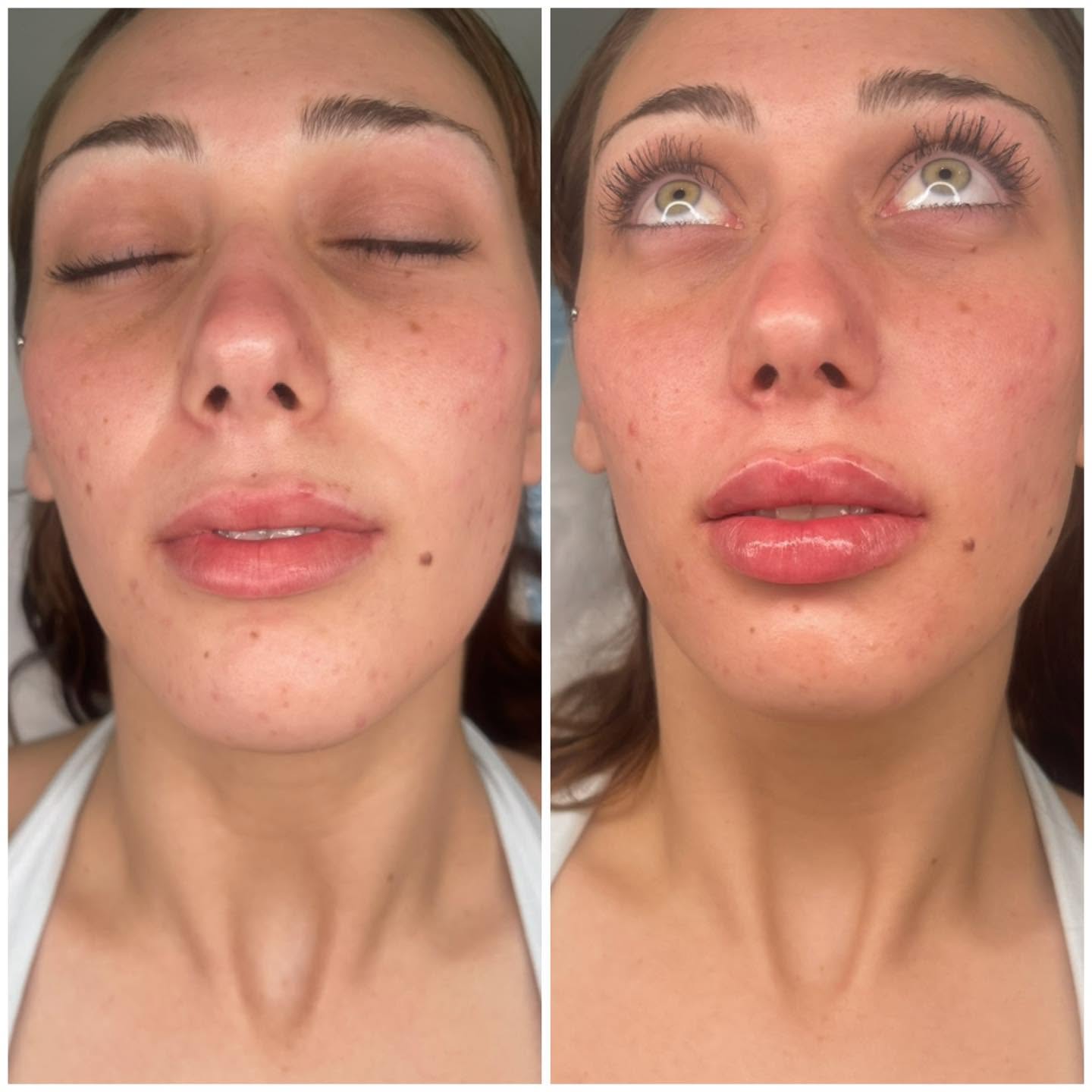 Before and after photograph showing lip volume and border definition.