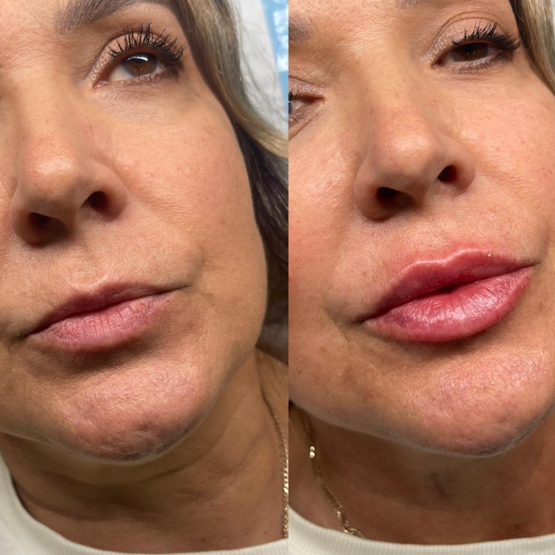 Before and after photograph of lips and surrounding mature skin.