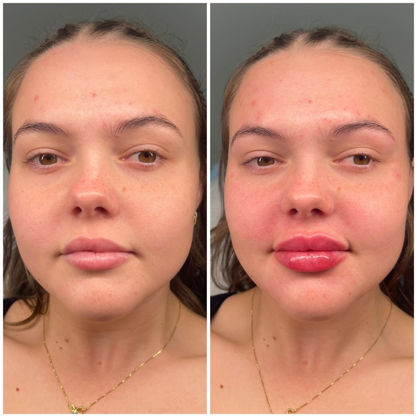 Before and after photograph showing lip shape and proportion, front view.