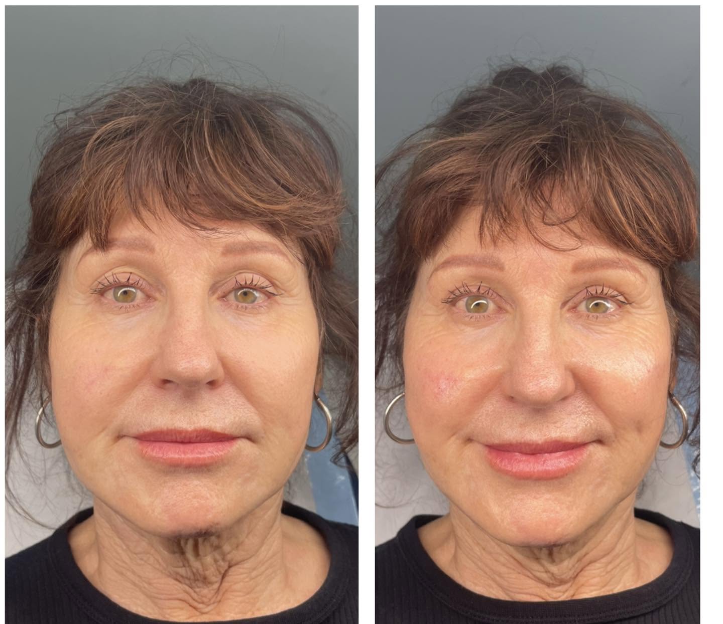 Before and after photograph showing skin firmness.