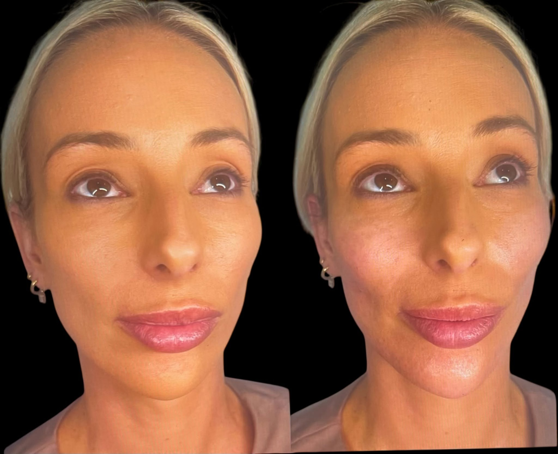 Before and after photograph showing lower face contour.